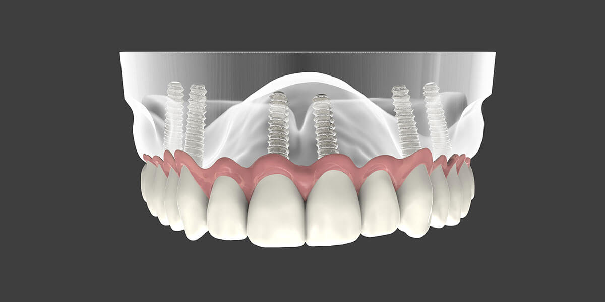 Dental Implants